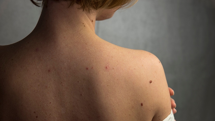 脫疣全攻略-疣的成因-種類及治療比較-專業醫學去疣方法解析